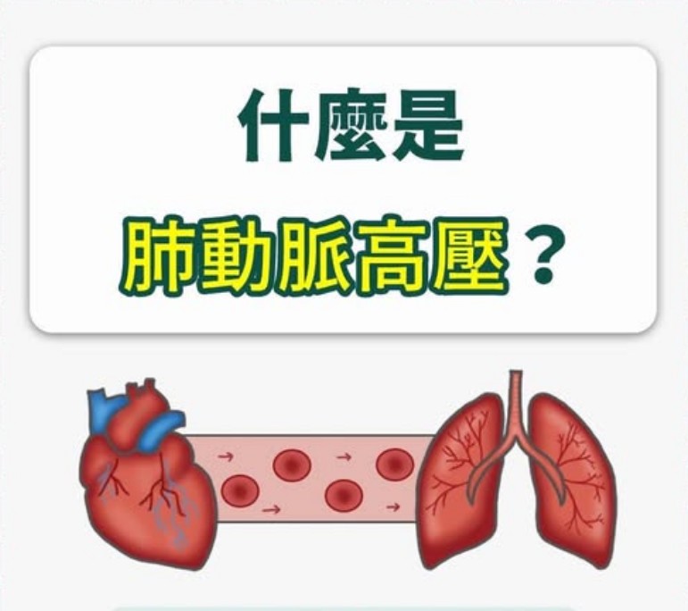 什麼是肺動脈高壓？